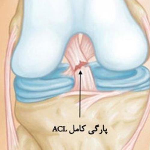 تمرینات توانبخشی پس از جراحی رباط صلیبی + عکس